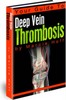 Thumbnail Your Guide To Deep Vein Thrombosis