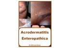 Thumbnail Acrodermatitis Enteropathica