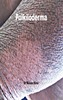 Thumbnail Poikiloderma