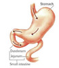 Thumbnail 25 Fresh Article PLR about Gastric Bypass for Disember 2011