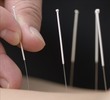 Thumbnail What is Acupuncture?