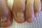 Thumbnail Infecciones: Los Síntomas, Causas, Cura Hongos en Las Uñas