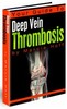 Thumbnail Your Guide To Deep Vein Thrombosis
